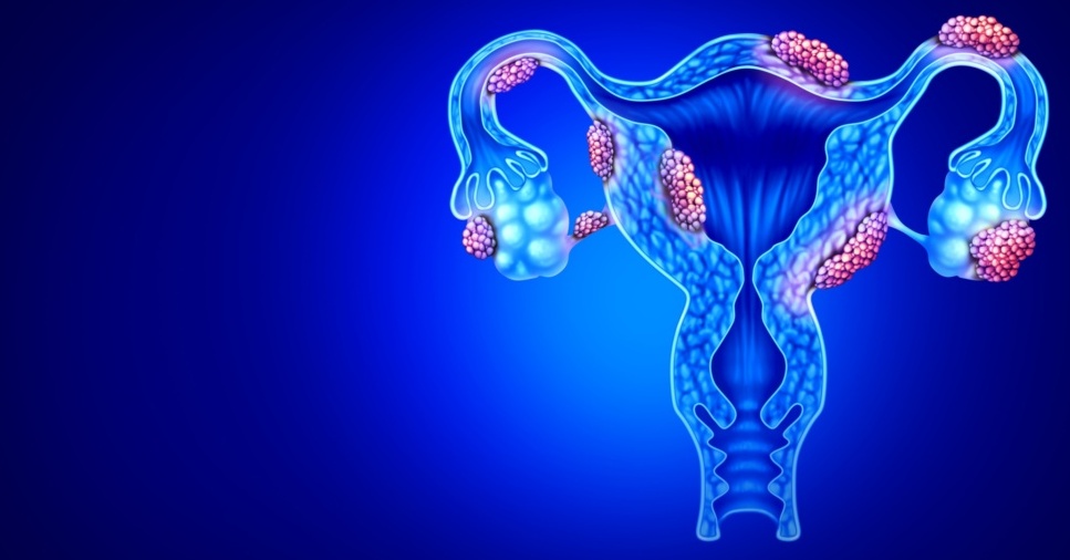Endometriosis,Disease,Anatomy,Concept,Of,Female,Infertility,Condition,As,Uterus